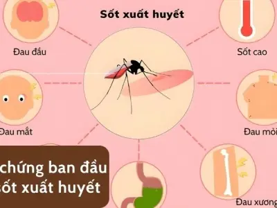 Dấu hiệu cảnh báo sốc sốt xuất huyết - Đừng bỏ qua!