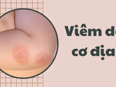 Viêm da cơ địa khiến da ngứa ngáy, khó chịu kéo dài