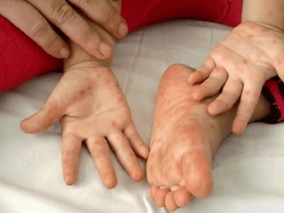 Bệnh chân tay miệng ở trẻ: Nhận biết, phòng ngừa và điều trị hiệu quả