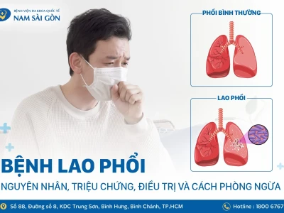 Bệnh lao phổi có chữa được không? Phác đồ điều trị và tiên lượng