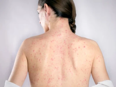 Bệnh Sởi Ở Người Lớn: Nguy Hiểm Tiềm Ẩn Và Cách Nhận Biết Sớm