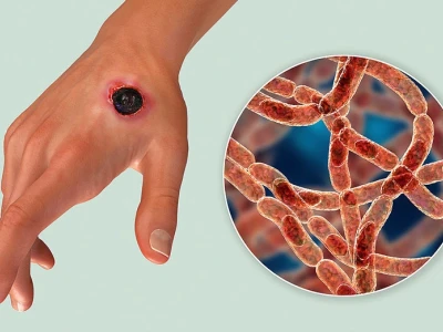 Bệnh Than Là Gì? Triệu Chứng, Nguyên Nhân Và Cách Điều Trị Bệnh Than Ở Người