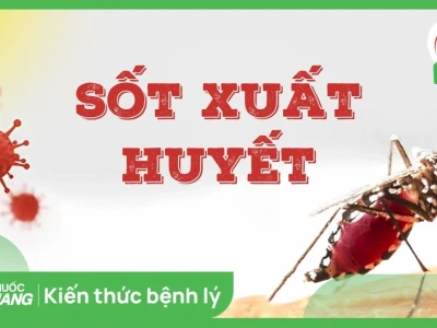 Biểu hiện bệnh sốt xuất huyết: Nhận biết sớm, phòng ngừa hiệu quả