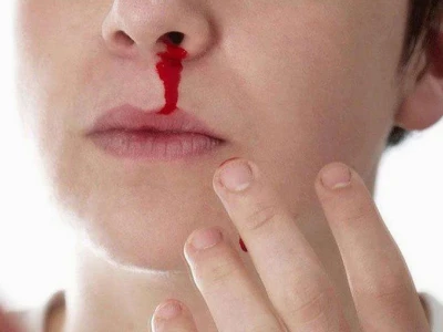 Chảy máu mũi tự nhiên là dấu hiệu bệnh gì? Nguyên nhân và cách xử lý