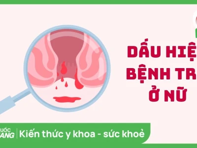 Dấu hiệu bệnh trĩ ở phụ nữ: Nhận biết sớm để điều trị kịp thời