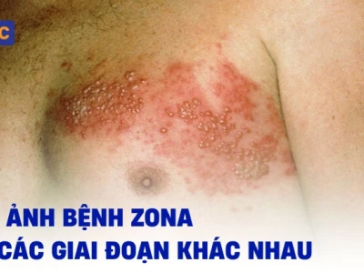 Hình ảnh bệnh zona thần kinh: Nhận biết sớm và phòng tránh