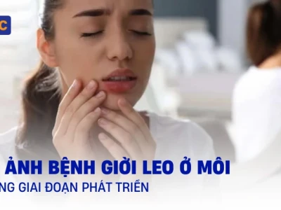 Hình ảnh Giời Leo: Nhận biết, phòng tránh và cách điều trị