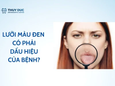 Lưỡi Bị Đen Là Bệnh Gì? Nguyên Nhân Và Cách Xử Lý Hiệu Quả