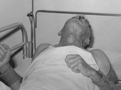 Nhận biết dấu hiệu bệnh dại giai đoạn đầu ở người